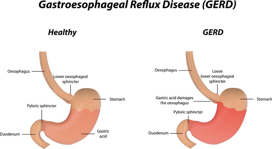 Acid Reflux Disease Symptoms, Reflux diet, Tests, &amp; Treatments