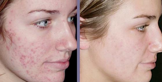 Revitol Scar