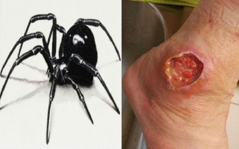 Black Widow Bite Causes Symptoms Treatments Important Details Black Widow Bite Causes Symptoms Treatments Important Details