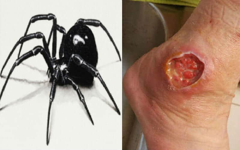 Black Widow Bite – Causes Symptoms Treatments & Important Details