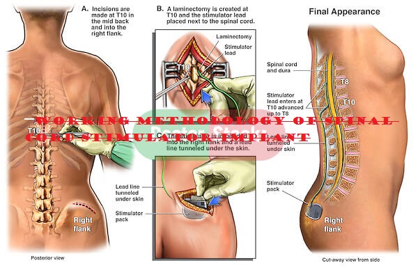 Spinal Cord Stimulator Implant