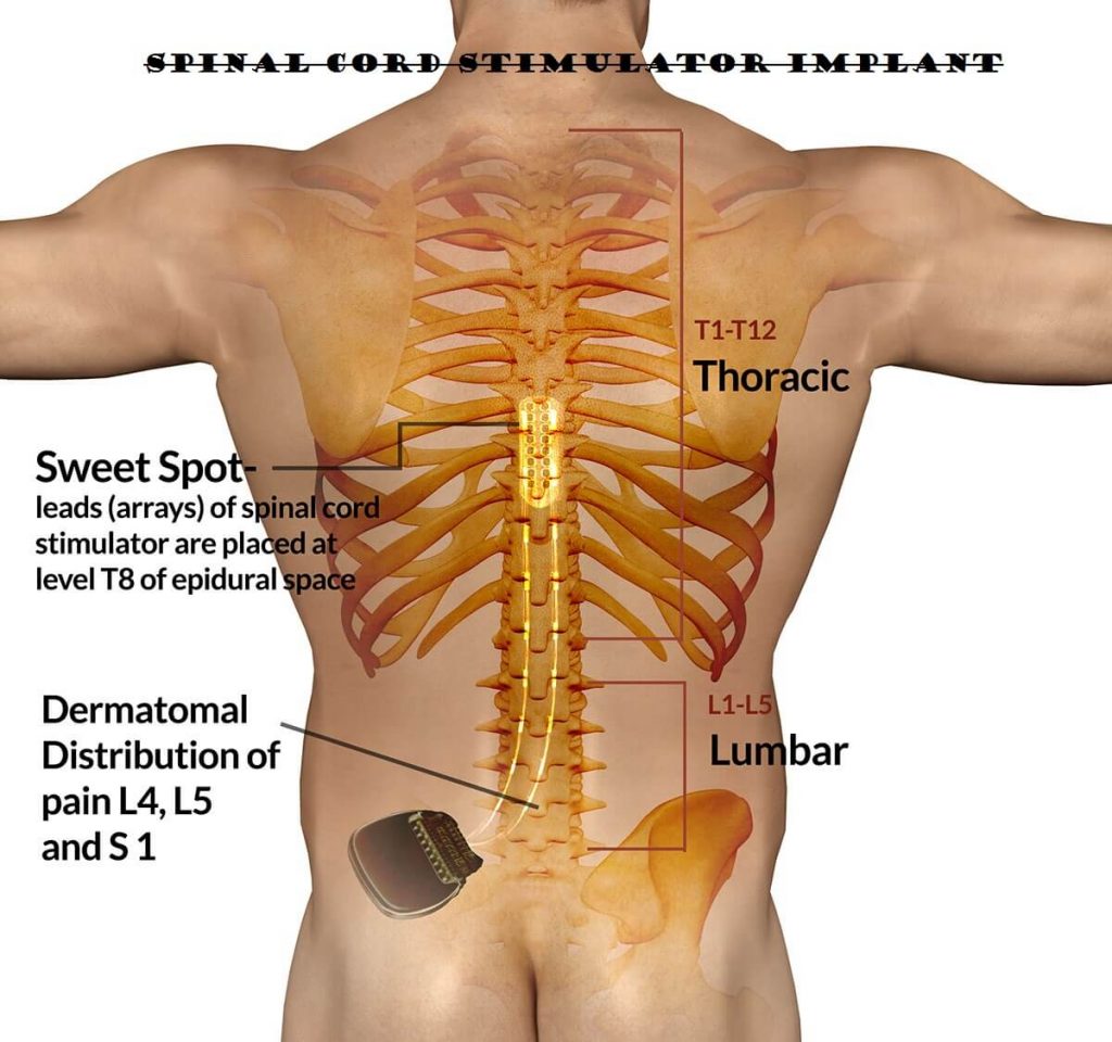 Spinal Cord Stimulator Implant