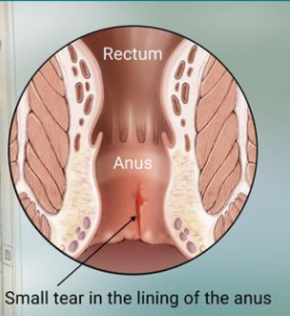 Anal Fissure