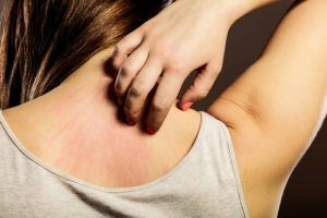 scabies causes symptoms and treatment