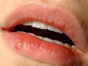 Genital Herpes