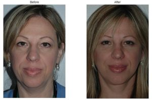 Revision Rhinoplasty