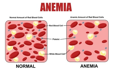 Iron Deficiency Anemia