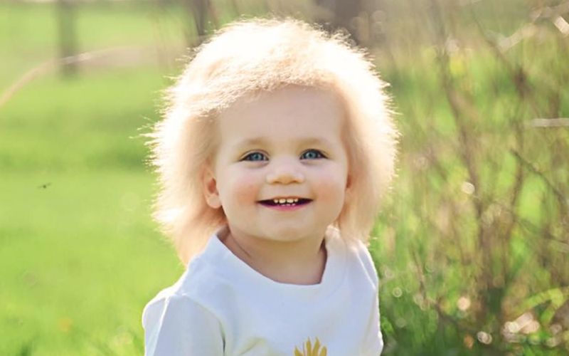 Uncombable Hair Syndrome