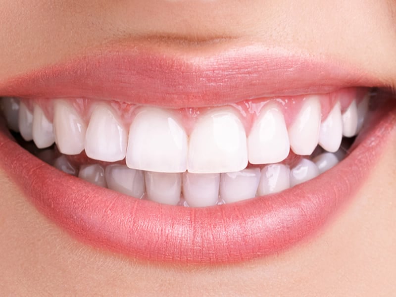 Tooth Whitening