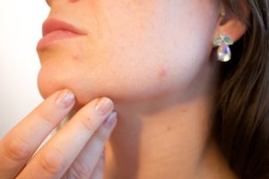 How to Treat Acne with Retinoid Adapalene