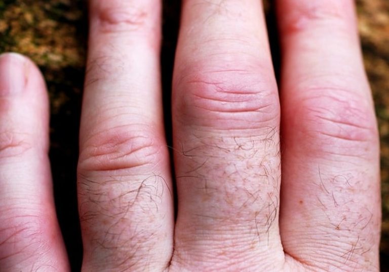 Facts About Arthritis