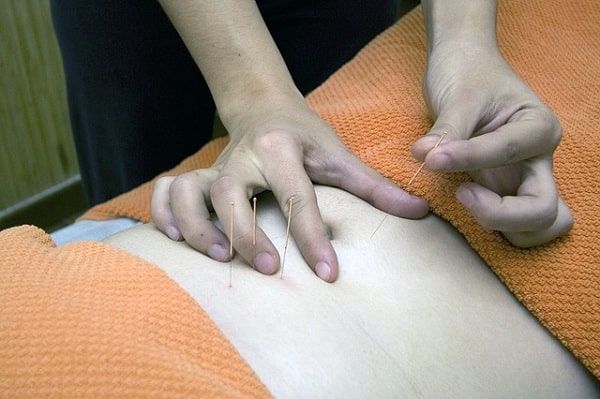 Permanent Acupuncture Treatment