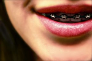 braces