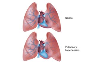 copd