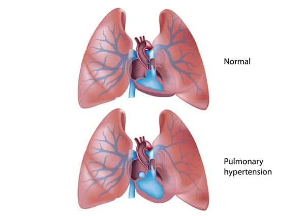 copd
