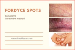 Fordyce spots