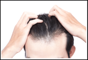 Hair Loss