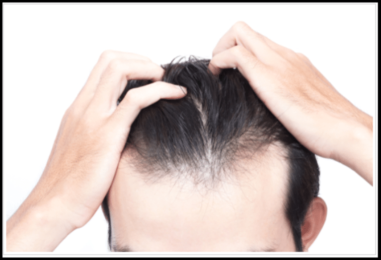 Hair Loss