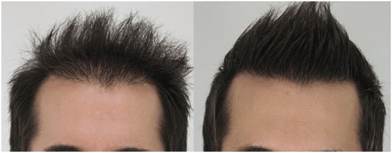 Best Hair Transplant in Chennai
