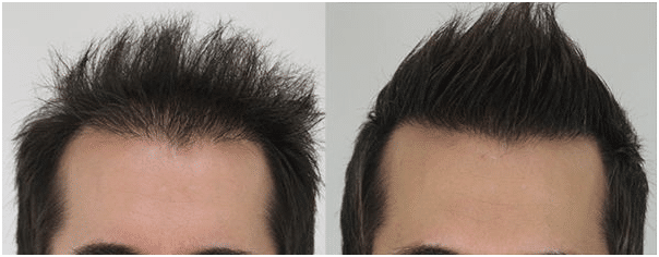 Best Hair Transplant in Chennai