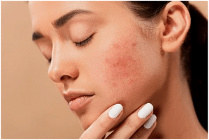 Proven Ways to Fight Acne