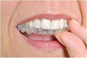 Invisalign Treatment