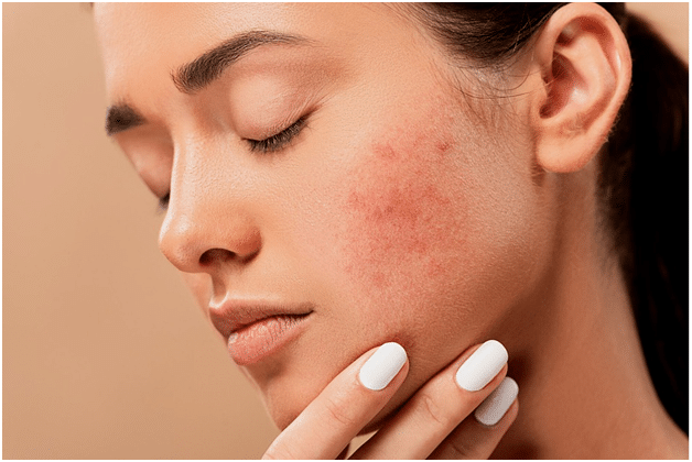Acne Treatment Methods