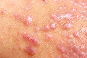 Dermatitis