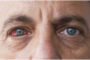 Diabetic Eye Exams