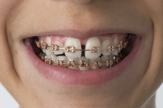 braces