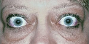Ocular Disease