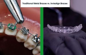 Traditional Metal Braces vs. Invisalign Braces