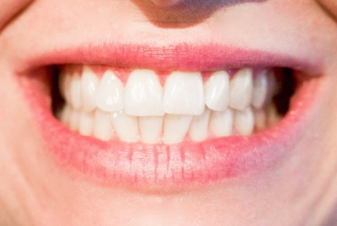 Best Teeth Whitening Products