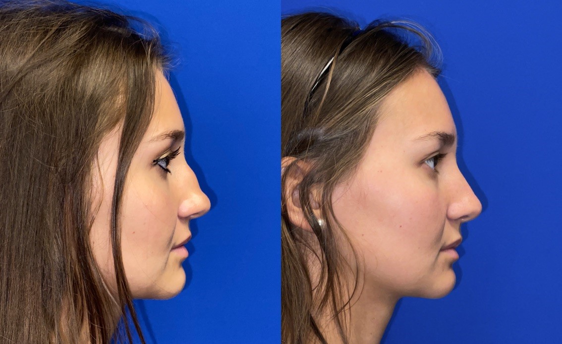 Rhinoplasty
