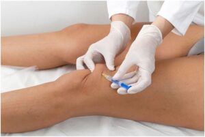 Hyaluronic Acid Injection