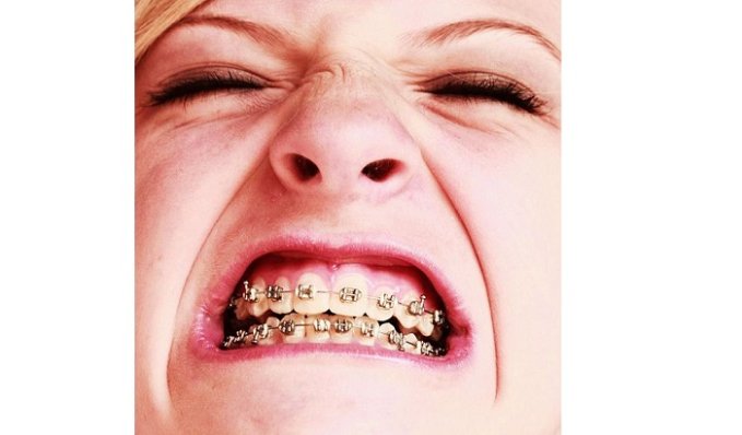 Celebrities Who Had Braces or Invisalign