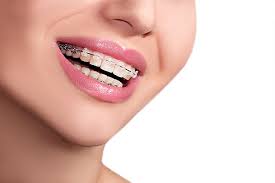 Lingual Braces