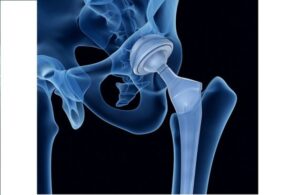 Benefits Of Joint Replacement Surgery