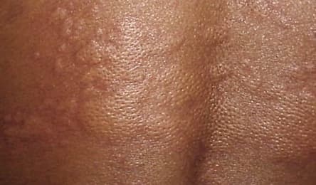 Hives on Darker Skin