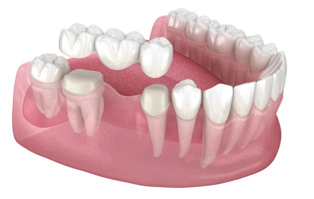 Dental Crown vs. Bridge