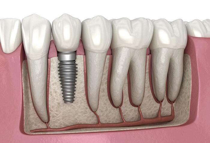 Vital Factors for getting dental implants