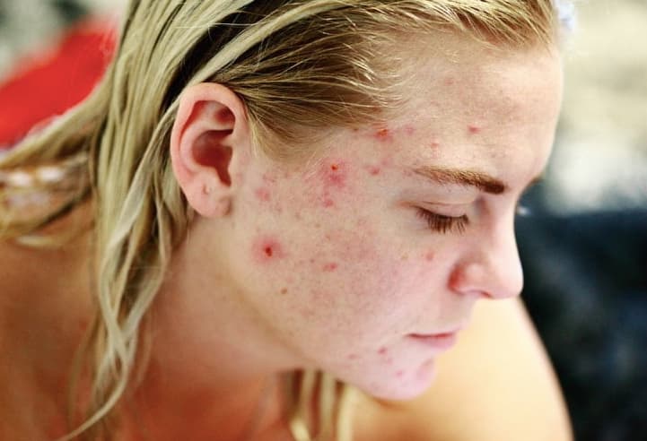 What Does Pregnancy Acne Look Like