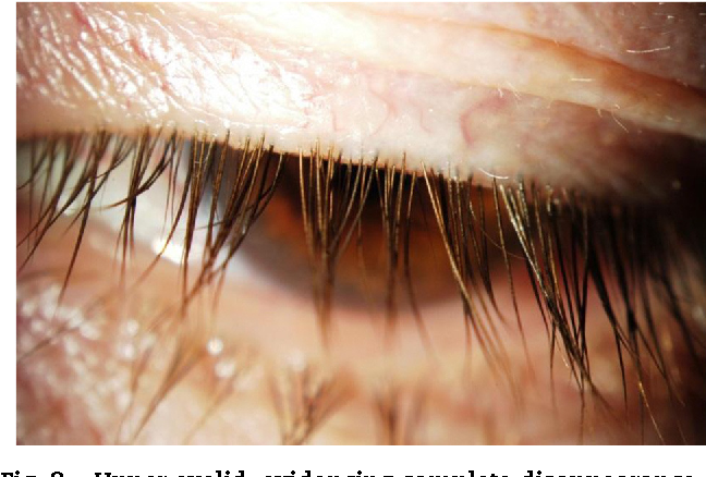 Demodex Blepharitis