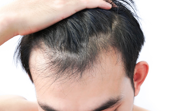 Effective Hair Restoration