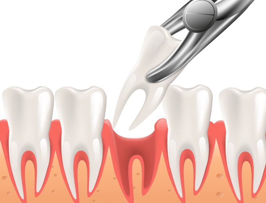 How Long Should I Wait to Smoke After Getting a Tooth Pulled