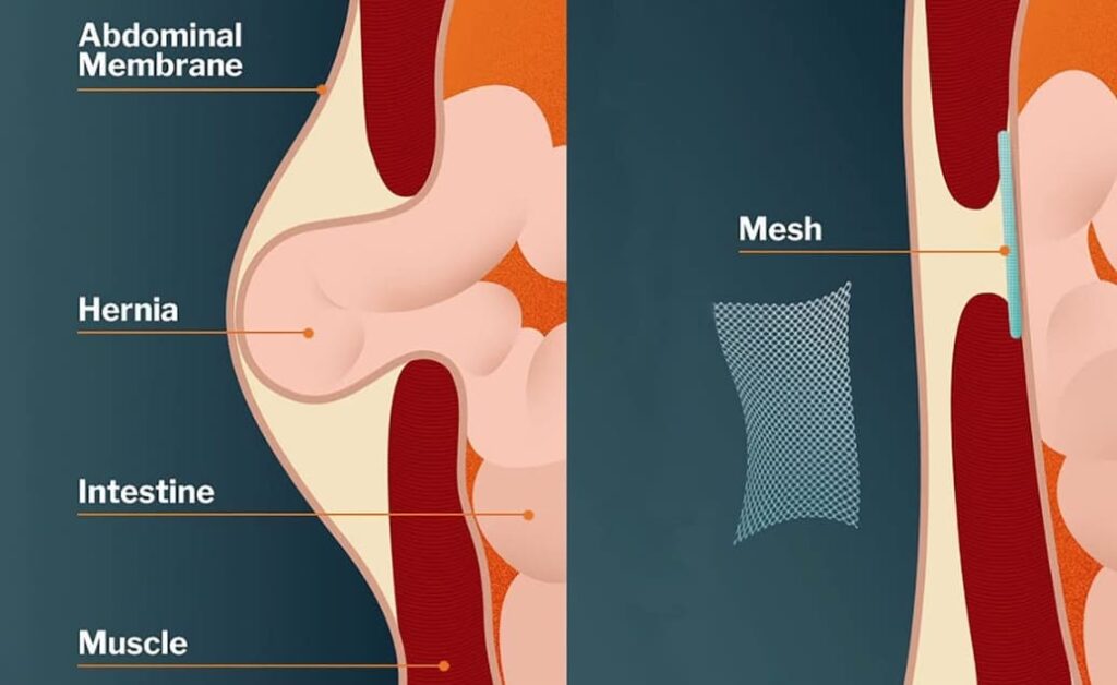 How Long Should I Wait to Smoke After Hernia Surgery