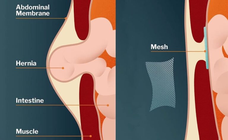 How Long Should I Wait to Smoke After Hernia Surgery