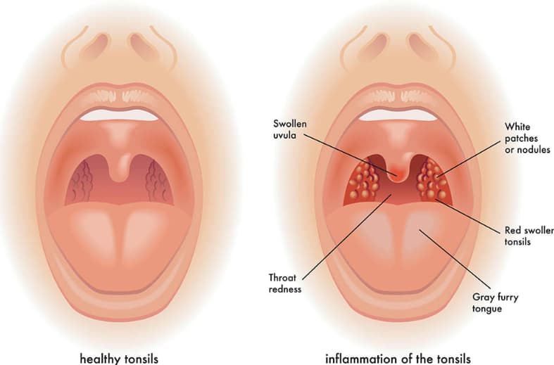 How Long Should I Wait to Smoke After Tonsillitis