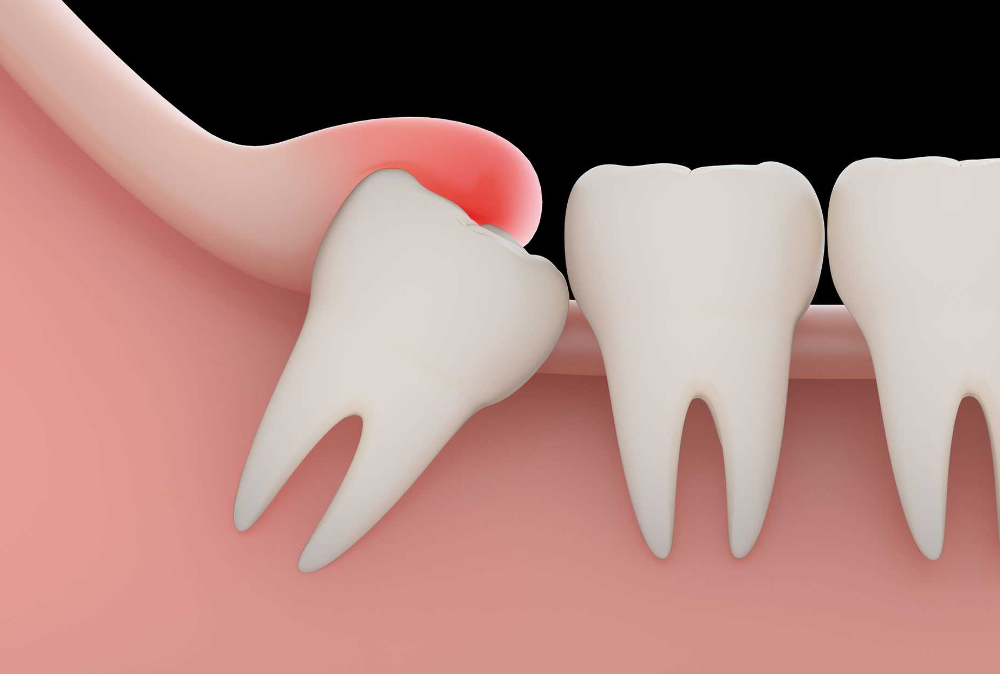 How Long Should I Wait to Smoke After Wisdom Teeth Removal