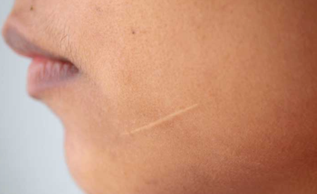 Acne Scars with Microneedling